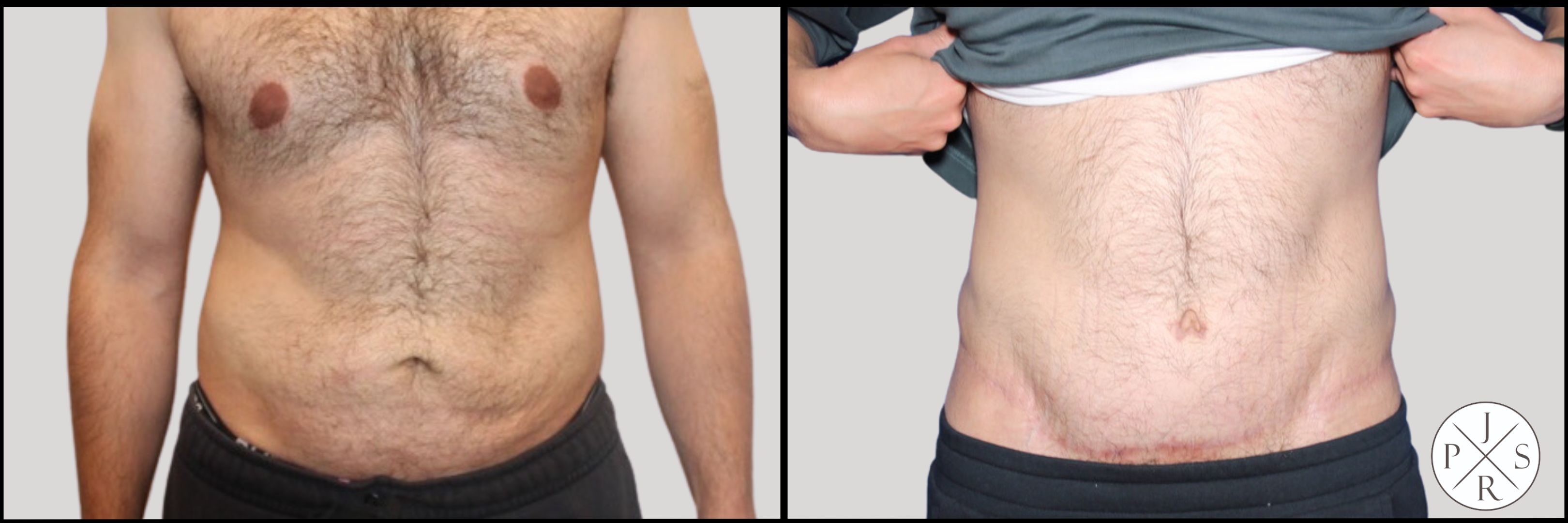 Abdominoplasty Before & After Image